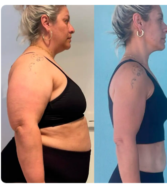 Antes e depois de Luna Gemelli